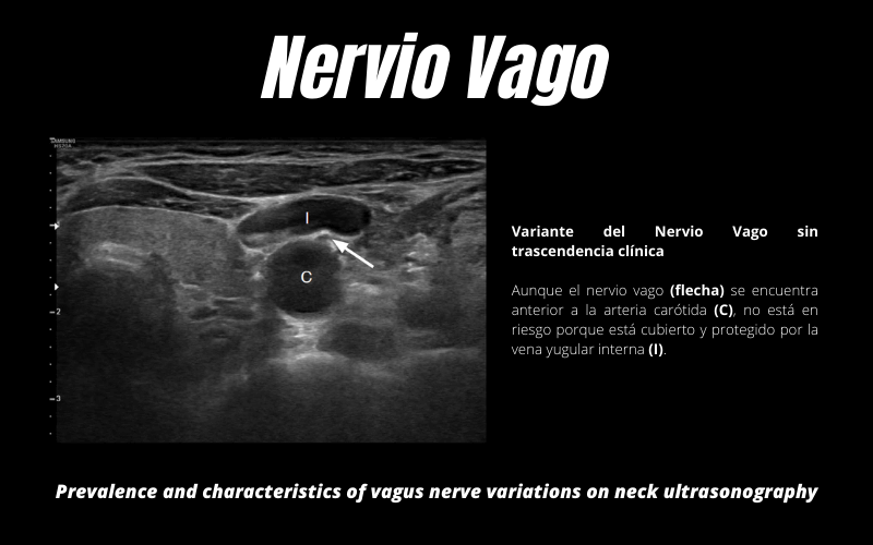 2. Nervio Vago Ecografia Articulo.png